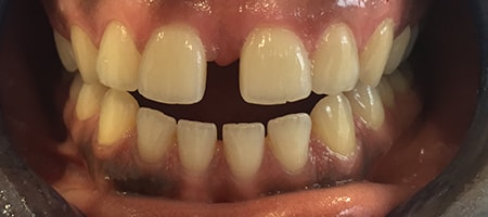 Before Invisalign Treatment Reading Smiles